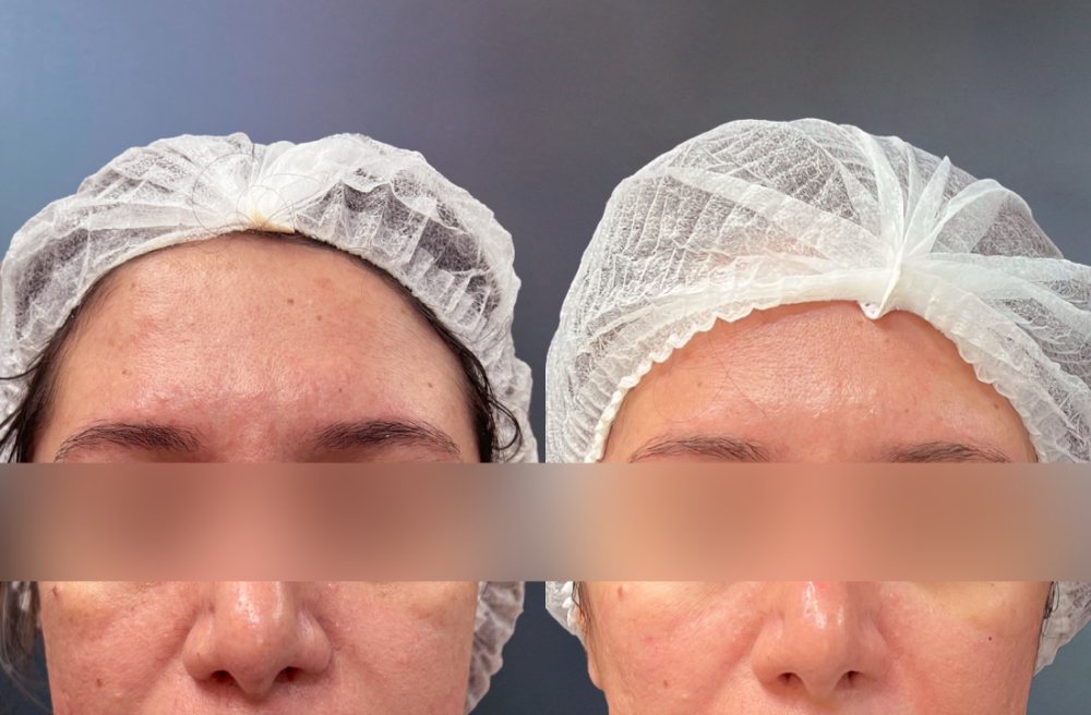 Antes e depois, Megaderme, 60 dias após aplicação