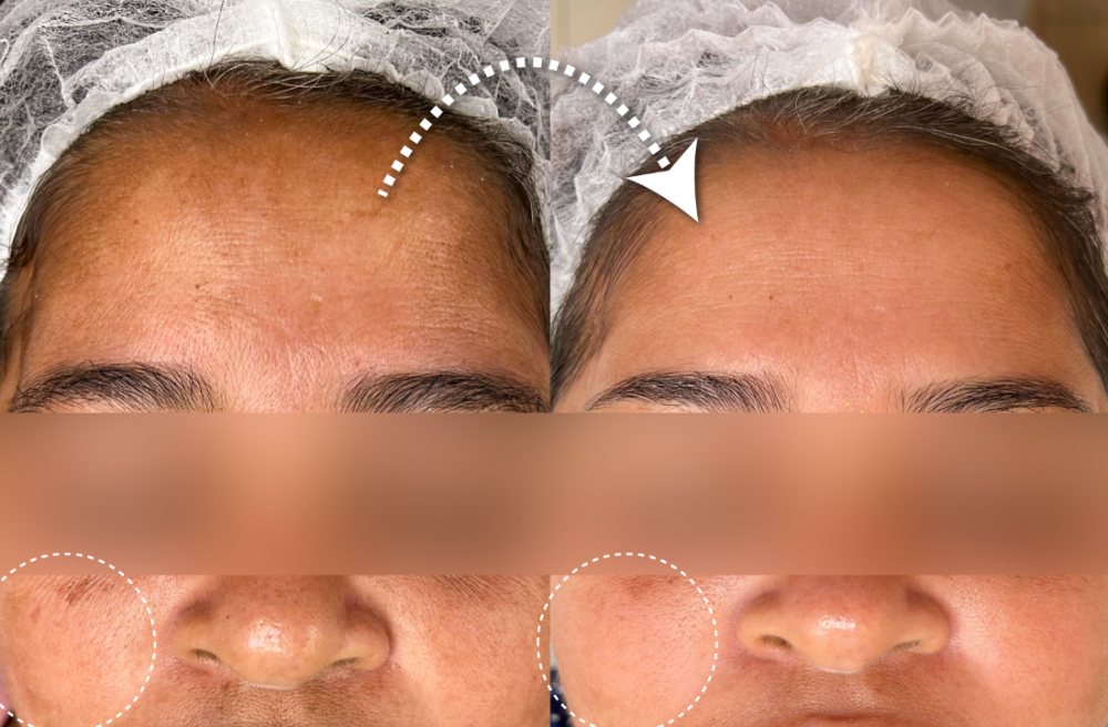 Antes e depois, Melasma, Laser ND YAG