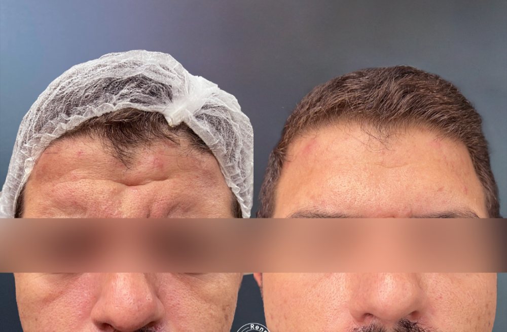 Antes e depois, Rugas profundas, Megaderme + Botox